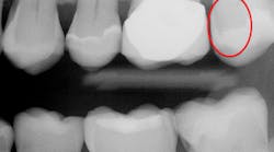 Figure 1: Bitewing radiograph made with a state-of-the-art CMOS sensor shows only a few suspect areas of caries.