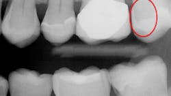 Figure 1: Bitewing radiograph made with a state-of-the-art CMOS sensor shows only a few suspect areas of caries. Figure 1: Bitewing radiograph made with a state-of-the-art CMOS sensor shows only a few suspect areas of caries.