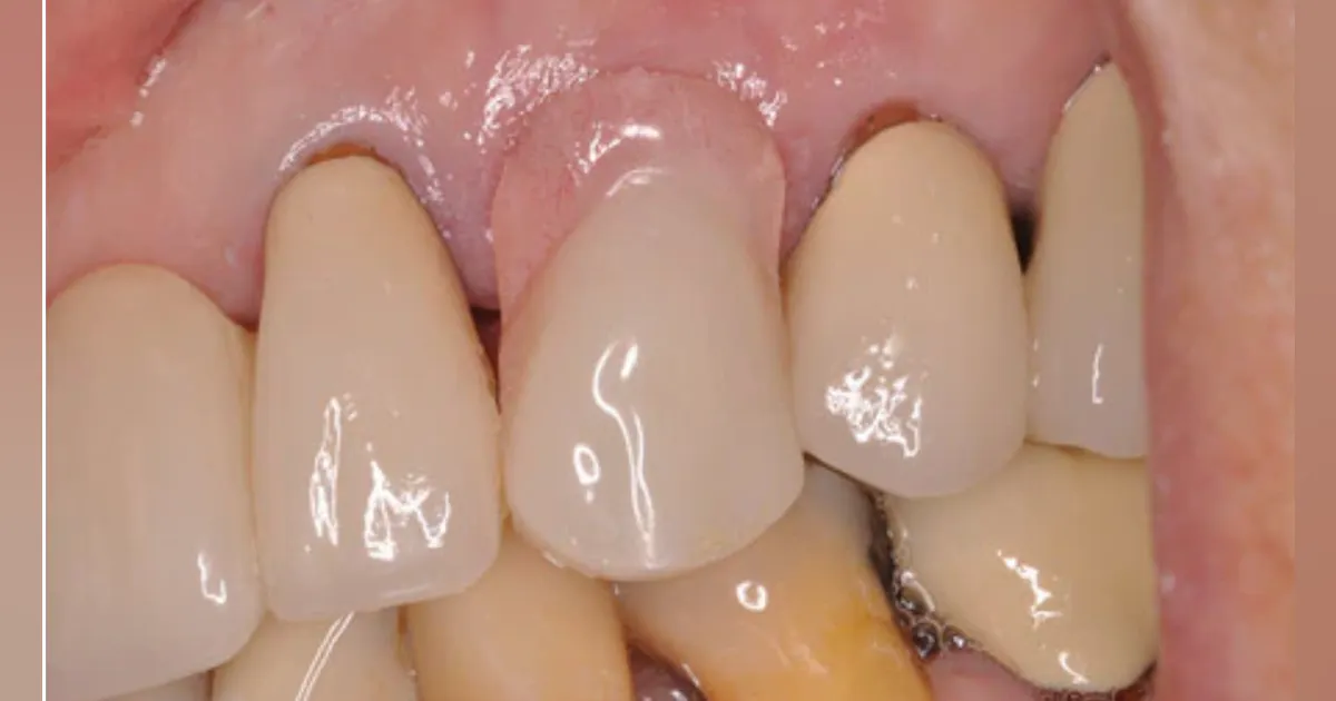 Front Flipper Dental A Detailed Description About The Dental Flippers