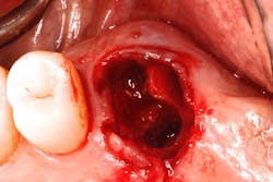 Figure 3: Clinical occlusal image of a maxillary molar extraction site immediately after removal of the nonrestorable tooth Figure 3: Clinical occlusal image of a maxillary molar extraction site immediately after removal of the nonrestorable tooth