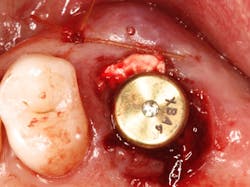 Figure 4: Clinical occlusal image of the maxillary molar extraction site in Figure 3 immediately after placement of the 7 mm MAX implant and healing abutment. Note that the implant almost completely obturated the molar extraction site. A bone graft and membrane were placed on the buccal surface of the extraction site. Figure 4: Clinical occlusal image of the maxillary molar extraction site in Figure 3 immediately after placement of the 7 mm MAX implant and healing abutment. Note that the implant almost completely obturated the molar extraction site. A bone graft and membrane were placed on the buccal surface of the extraction site.