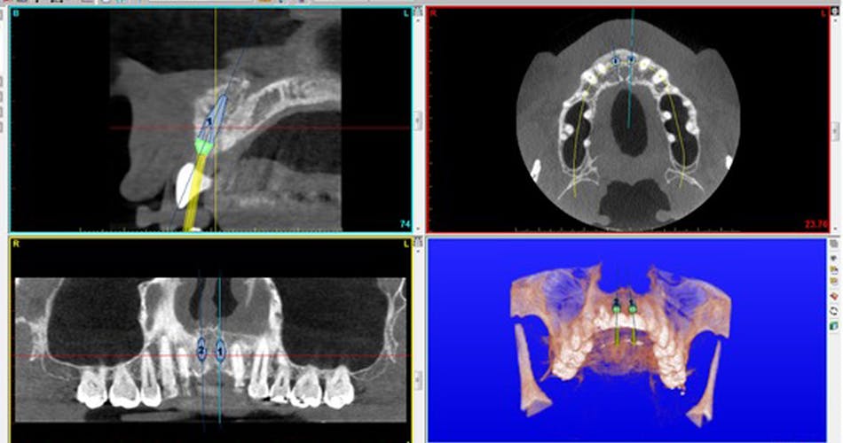 Figure 5: Treatment planning for implant placement of two missing maxillary central incisors. Upper left: blue line indicates the location of the screw access opening for a straight implant. The angle correction has occurred at the occlusal aspect of the implant, and the screw access opening is now located in the cingulum area.