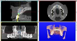 Figure 5: Treatment planning for implant placement of two missing maxillary central incisors. Upper left: blue line indicates the location of the screw access opening for a straight implant. The angle correction has occurred at the occlusal aspect of the implant, and the screw access opening is now located in the cingulum area. Figure 5: Treatment planning for implant placement of two missing maxillary central incisors. Upper left: blue line indicates the location of the screw access opening for a straight implant. The angle correction has occurred at the occlusal aspect of the implant, and the screw access opening is now located in the cingulum area.