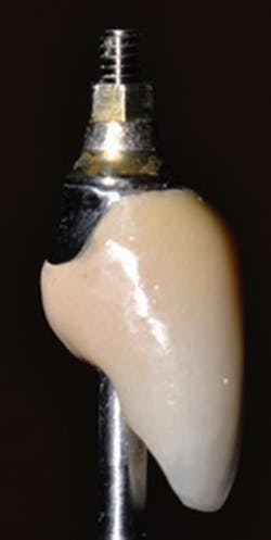 Figure 6: Laboratory image of one of the crowns planned for in Figure 5. A laboratory screw is in place and identifies the location of the screw access opening in the crown restoration as designed in the CBCT scan. Figure 6: Laboratory image of one of the crowns planned for in Figure 5. A laboratory screw is in place and identifies the location of the screw access opening in the crown restoration as designed in the CBCT scan.