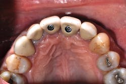 Figure 7: Clinical occlusal image of the implant crown restorations for the maxillary central incisors that were treatment planned in Figure 5. Note the cingulum locations of the screw access openings. Figure 7: Clinical occlusal image of the implant crown restorations for the maxillary central incisors that were treatment planned in Figure 5. Note the cingulum locations of the screw access openings.