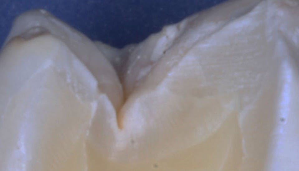 Figure 2: Note the narrow groove in a typical tooth. Instruments such as explorers fail to reach the plaque in the depth of most grooves. Rotating brushes and prophy cups clean only the superficial areas of the occlusal surface, leaving the plaque in the grooves.