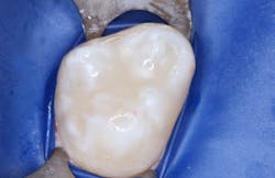 Figure 4: The sealant in this extracted tooth example was placed with the technique described in this article. Such sealants will not fail!