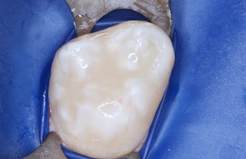 Figure 4: The sealant in this extracted tooth example was placed with the technique described in this article. Such sealants will not fail!