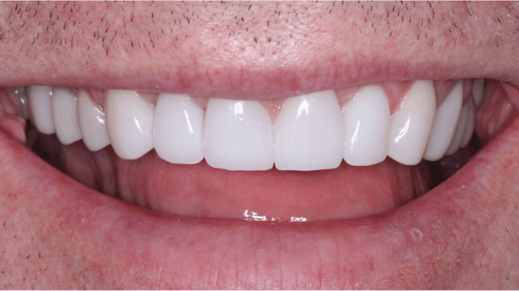 What cement type is best? Dental Economics