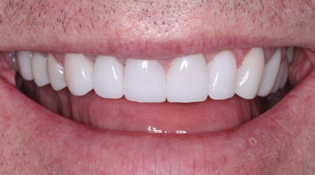 Bonding cement hot sale for teeth