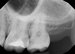 Figure 1: Preoperative radiograph of tooth no. 15 Figure 1: Preoperative radiograph of tooth no. 15