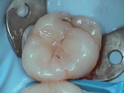 Figure 2: Isolated tooth ready for caries removal Figure 2: Isolated tooth ready for caries removal