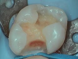 Figure 3: Fully prepared tooth after caries removal and cavosurface smoothing