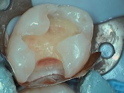 Figure 4: Sectional matrix in place and burnished to facilitate marginal adaptation Figure 4: Sectional matrix in place and burnished to facilitate marginal adaptation