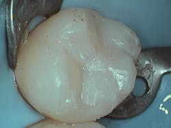 Figure 5: Tooth restored with Clearfil Majesty ES-2 Universal composite, prior to finishing