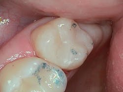 Figure 6: Immediate post-op view of restoration with contact points from articulating paper Figure 6: Immediate post-op view of restoration with contact points from articulating paper