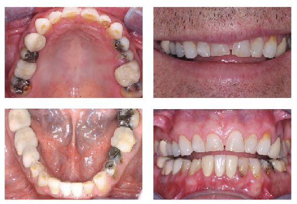 Figure 1: Preoperative view of male patient with heavy occlusion, ongoing caries, broken-off teeth, and the need for improved occlusion and esthetics. Posterior teeth were built up, and zirconia crowns were placed for optimum strength and acceptable esthetics. IPS e.max crowns were placed on the anterior teeth for their proven strength in the anterior and optimum esthetics.