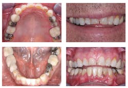 Figure 1: Preoperative view of male patient with heavy occlusion, ongoing caries, broken-off teeth, and the need for improved occlusion and esthetics. Posterior teeth were built up, and zirconia crowns were placed for optimum strength and acceptable esthetics. IPS e.max crowns were placed on the anterior teeth for their proven strength in the anterior and optimum esthetics. Figure 1: Preoperative view of male patient with heavy occlusion, ongoing caries, broken-off teeth, and the need for improved occlusion and esthetics. Posterior teeth were built up, and zirconia crowns were placed for optimum strength and acceptable esthetics. IPS e.max crowns were placed on the anterior teeth for their proven strength in the anterior and optimum esthetics.