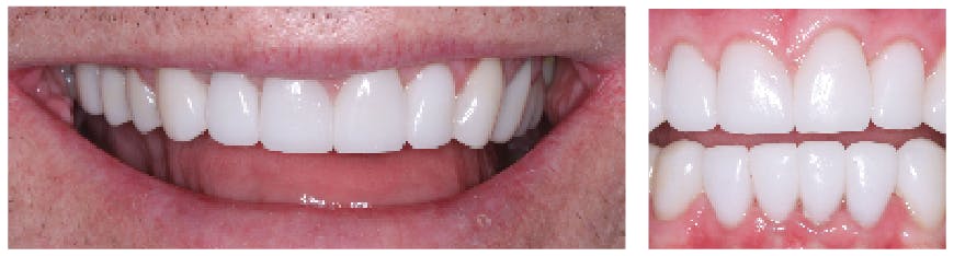 Figure 2: The posterior zirconia crowns were cemented with RMGI (3M RelyX Luting Plus), and the anterior IPS e.max crowns were cemented with resin cement (RelyX Unicem 2). Many other excellent brands of either cement could have been used in this case.