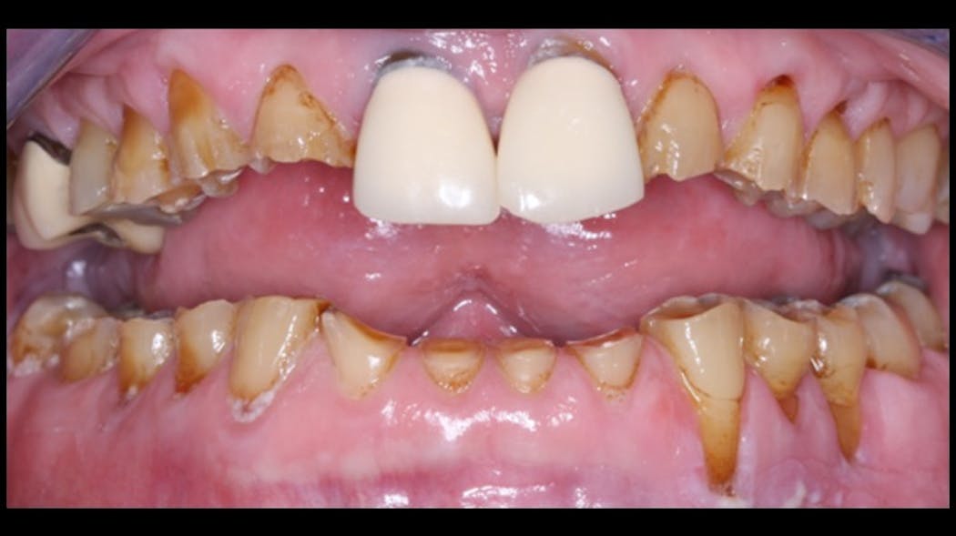 Figure 1: Placing implants and a fixed prosthesis in a patient such as this is highly questionable. The likelihood of long-term service is low. When implants are placed in edentulous or partially edentulous bruxing patients, removable prostheses with resin teeth allow progressive wear and adjustment of the teeth as well as reduced trauma to the implants, whereas rigid ceramic restorations do not wear appreciably.