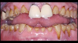 Figure 1: Placing implants and a fixed prosthesis in a patient such as this is highly questionable. The likelihood of long-term service is low. When implants are placed in edentulous or partially edentulous bruxing patients, removable prostheses with resin teeth allow progressive wear and adjustment of the teeth as well as reduced trauma to the implants, whereas rigid ceramic restorations do not wear appreciably. Figure 1: Placing implants and a fixed prosthesis in a patient such as this is highly questionable. The likelihood of long-term service is low. When implants are placed in edentulous or partially edentulous bruxing patients, removable prostheses with resin teeth allow progressive wear and adjustment of the teeth as well as reduced trauma to the implants, whereas rigid ceramic restorations do not wear appreciably.