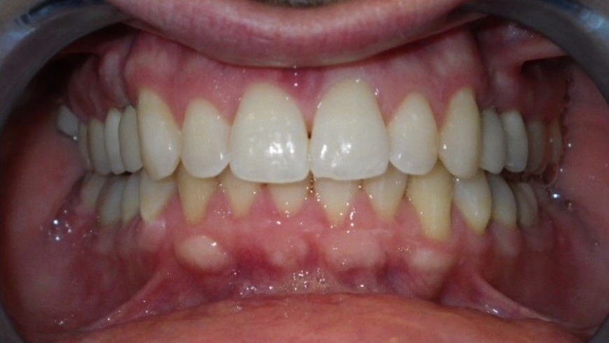 Figure 11: The patient has a healthy, stable, functional, and comfortable occlusion.