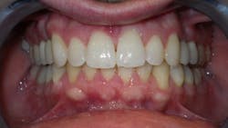 Figure 11: The patient has a healthy, stable, functional, and comfortable occlusion. Figure 11: The patient has a healthy, stable, functional, and comfortable occlusion.
