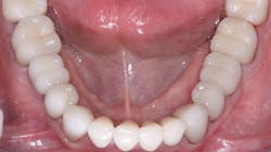 Figure 3: This rehabilitation, now in service for about five years, has IPS e.max on all teeth except the four molars. The 3Y, class 5 tetragonal full-strength zirconia on the molars was stained in the presintered stage, resulting in esthetics similar to e.max but without external staining. Figure 3: This rehabilitation, now in service for about five years, has IPS e.max on all teeth except the four molars. The 3Y, class 5 tetragonal full-strength zirconia on the molars was stained in the presintered stage, resulting in esthetics similar to e.max but without external staining.