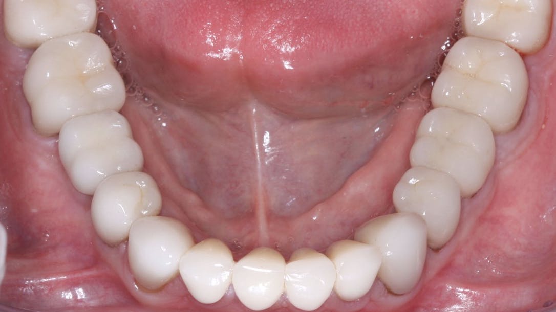 Figure 3: This rehabilitation, now in service for about five years, has IPS e.max on all teeth except the four molars. The 3Y, class 5 tetragonal full-strength zirconia on the molars was stained in the presintered stage, resulting in esthetics similar to e.max but without external staining.