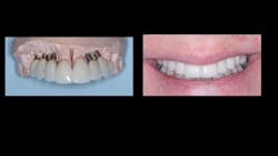 Figure 4: Although improperly placed implants, as shown in these two examples, can be restored with adequate laboratory expertise, the potential for implant success may be significantly compromised. Figure 4: Although improperly placed implants, as shown in these two examples, can be restored with adequate laboratory expertise, the potential for implant success may be significantly compromised.