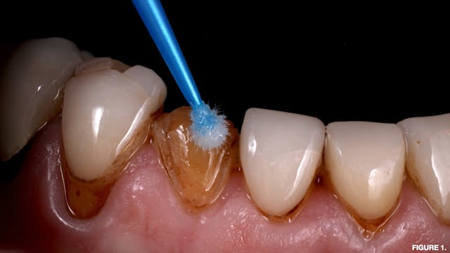 Figure 1: Adhesive Enhancing Primer (AEP) applied to tooth preparation with a microbrush