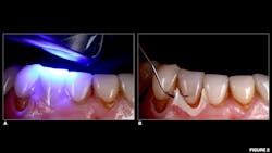 Figure 2: a: Light-curing excess cement to allow for b: removal of excess cement Figure 2: a: Light-curing excess cement to allow for b: removal of excess cement