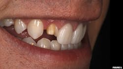 Figure 3: Fractured feldspathic veneer with limited hard tissue anatomy Figure 3: Fractured feldspathic veneer with limited hard tissue anatomy