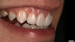 Figure 4: Adhesively bonded lithium disilicate restoration (LiSi Press, GC America) Figure 4: Adhesively bonded lithium disilicate restoration (LiSi Press, GC America)