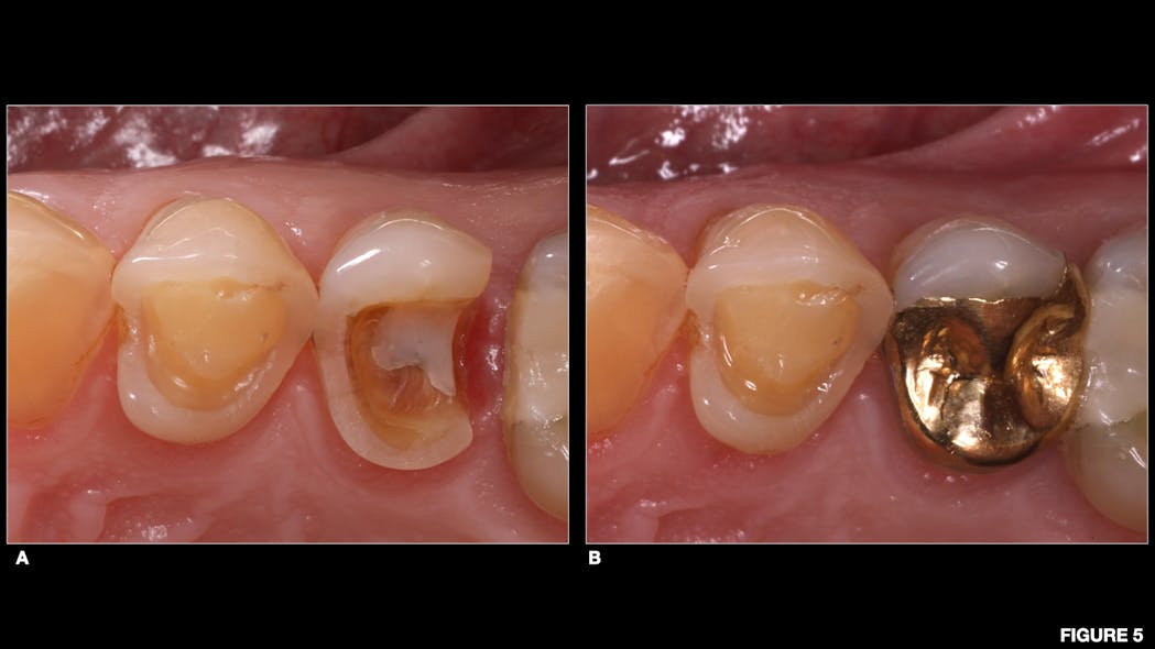 Figure 5: a: Onlay preparation tooth no. 13 for cast-gold restoration, b: final result of cast-gold onlay tooth no. 13