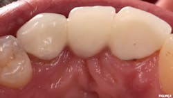 Figure 6: Occlusal view of debonded abutment tooth no. 6, and recurrent decay on abutment tooth no. 8 Figure 6: Occlusal view of debonded abutment tooth no. 6, and recurrent decay on abutment tooth no. 8