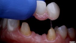 Figure 7: Try-in of layered zirconia FDP demonstrating overprepared tooth structure Figure 7: Try-in of layered zirconia FDP demonstrating overprepared tooth structure