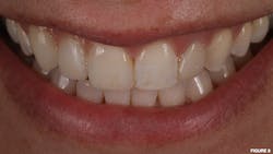 Figure 8: Definitive layered zirconia FDP demonstrating improved overall esthetics Figure 8: Definitive layered zirconia FDP demonstrating improved overall esthetics