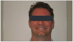 Figure 1: The patient presents a deficient smile line with a canine-to-canine only view.