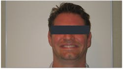 Figure 1: The patient presents a deficient smile line with a canine-to-canine only view. Figure 1: The patient presents a deficient smile line with a canine-to-canine only view.