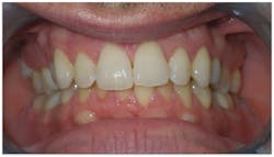 Figure 2: The patient diagnosis is class II crowded malocclusion with an underlying cause of maxillary underdevelopment. Figure 2: The patient diagnosis is class II crowded malocclusion with an underlying cause of maxillary underdevelopment.