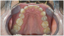 Figure 3: The patient has a narrow maxilla, 28 mm TM, and a vaulted palate. Figure 3: The patient has a narrow maxilla, 28 mm TM, and a vaulted palate.
