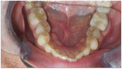 Figure 4: The patient presents with improper buccolingual inclination.