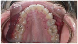 Figure 5: MOPS was performed on the buccal and lingual of the missing premolar sites.