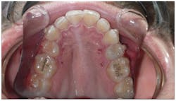 Figure 5: MOPS was performed on the buccal and lingual of the missing premolar sites. Figure 5: MOPS was performed on the buccal and lingual of the missing premolar sites.