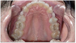 Figure 6: MOPS leads to better and faster bone remodeling. Figure 6: MOPS leads to better and faster bone remodeling.