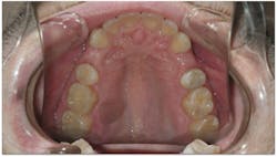 Figure 7: The extracted sites are fully developed and ready for implants. Figure 7: The extracted sites are fully developed and ready for implants.