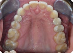 Figure 9: Two cementable crowns were placed on screw-retained custom abutments. Photo courtesy of Dr. Gene Goetz. Figure 9: Two cementable crowns were placed on screw-retained custom abutments. Photo courtesy of Dr. Gene Goetz.