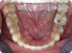 Figure 10: The lower arch has been expanded and aligned with clear aligner therapy.