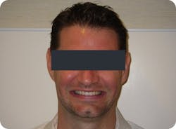 Figure 12: The patient now has a full display of teeth when smiling. Figure 12: The patient now has a full display of teeth when smiling.